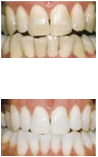 Go for safe teeth whitening treatment with Premier Laser Clinic